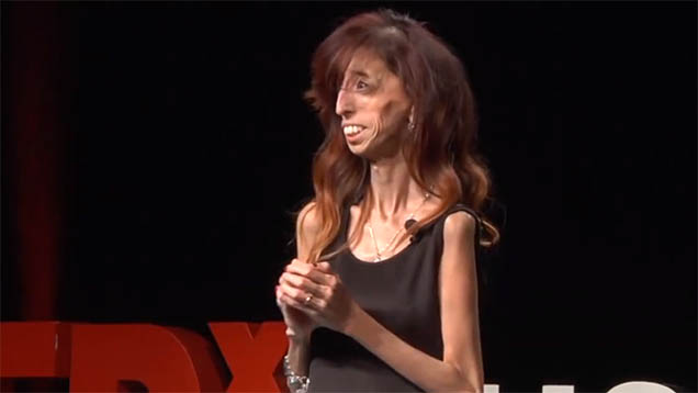 Lizzie Velasquez (24) leidet an einer extrem seltenen Krankheit, die sie nicht zunehmen lässt