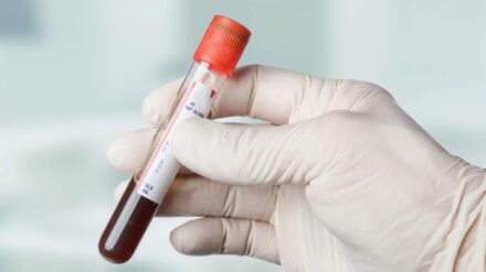 Ein Bluttest kann erkennen, ob bei ungeborenen Kindern ein Down-Syndrom vorliegt